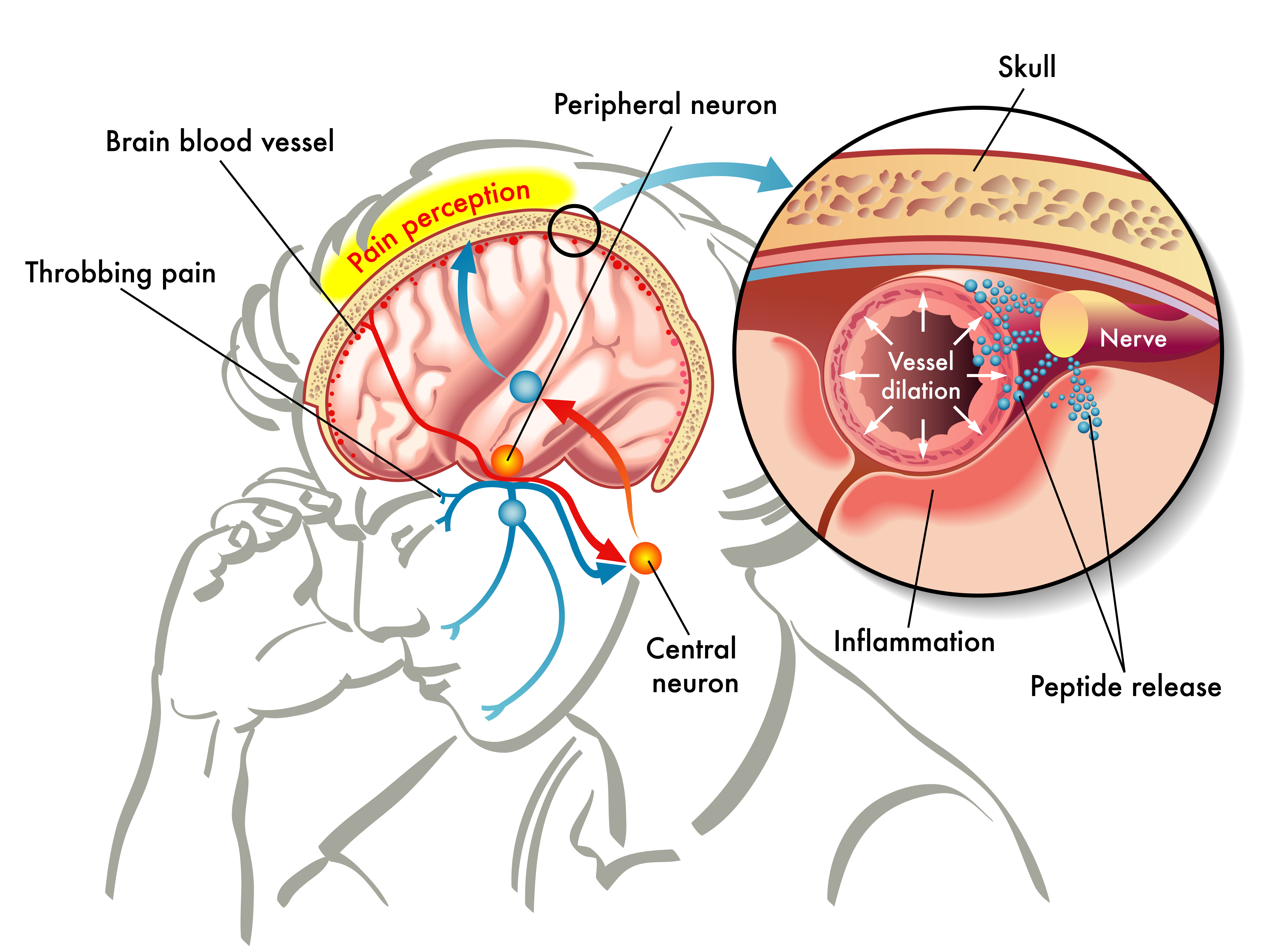 Tri-Amino - A Potential Instant Relief for Migraines