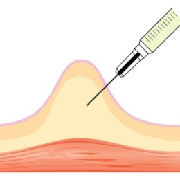 Subcutaneous Injections